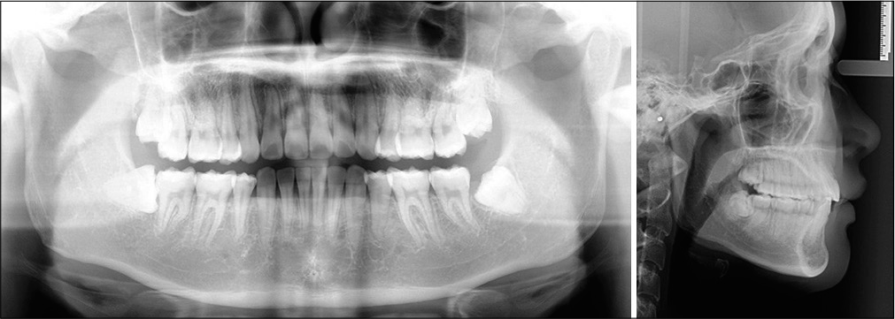 Post-treatment panoramic radiograph (left) and lateral cephalometric radiograph (right). Good root parallelism is noted in the maxillary buccal segments, but all the teeth are more upright than normal [Figure 3] which contributes to the Class II windows distal to the cusps of the U3s [Figure 11].