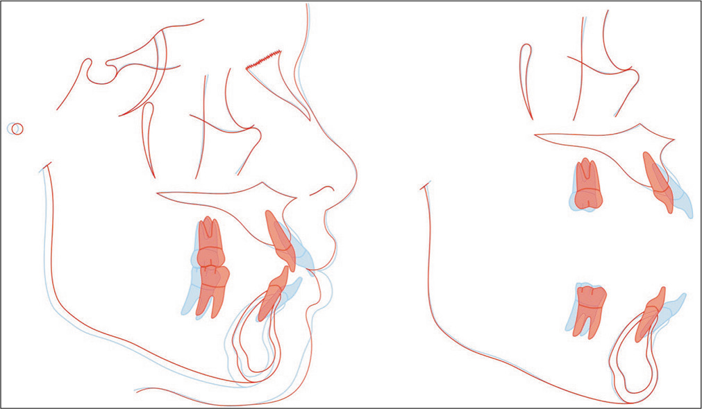 Superimposed tracings of the pre-treatment (blue) and post-treatment (red) lateral cephalometric radiographs show that bimaxillary protrusion was resolved dramatically (U1 and L1 retracted 6.5 and 5.5 mm, respectively). The intrusion of entire upper dentition (U1 and U6 intruded 2.2 and 1.5 mm, respectively) was consistent with the counterclockwise rotation of the mandible.