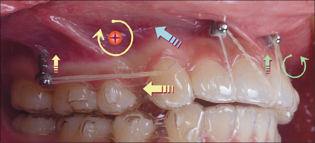 The force system is diagrammed in 2D to explain the mechanics in the sagittal plane for an infra-zygomatic crest (IZC) and Incisal OrthoBoneScrews®. Based on the presumed center of resistance (CR, red circle with a cross) for the maxillary arch, the elastic force from the IZC screws to the cuspid precision cut has both distal and vertical components (straight yellow arrows) that produce a clockwise moment around the CR (curved yellow arrow). The anterior inter-radicular screws anchor an intrusive force (green arrow) that creates a counterclockwise moment (curved green arrow) tending to flare the maxillary incisors. The presumed resultant for overall applied loads is the blue arrow.