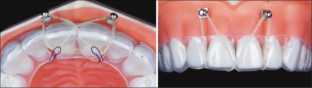 The application of anterior inter-radicular screws to anchor elastics fitted into palatal cuts (blue curved lines) in the aligners is shown in the occlusal view (left) and the frontal view (right). The palatal cuts inclined to the mesial are good attachments for elastics attached the Incisal OrthoBoneScrews® bilaterally.