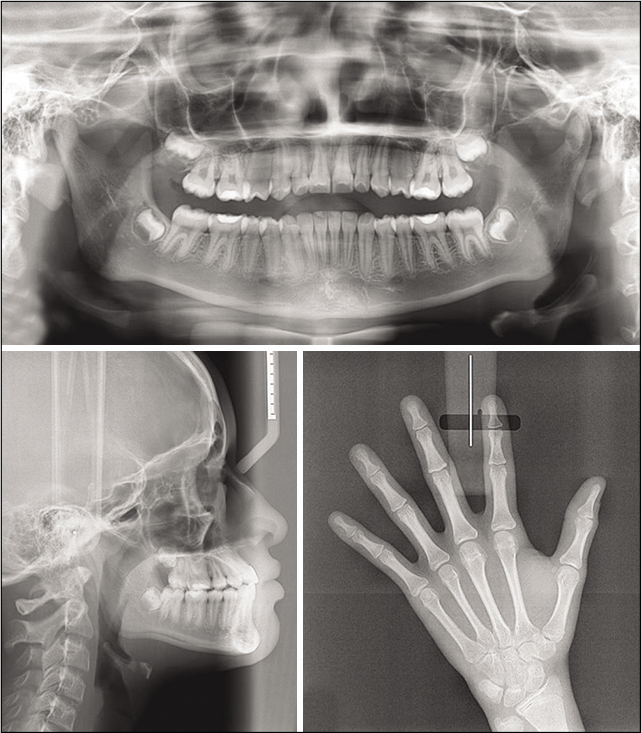 Final radiographic images after orthopedic treatment.