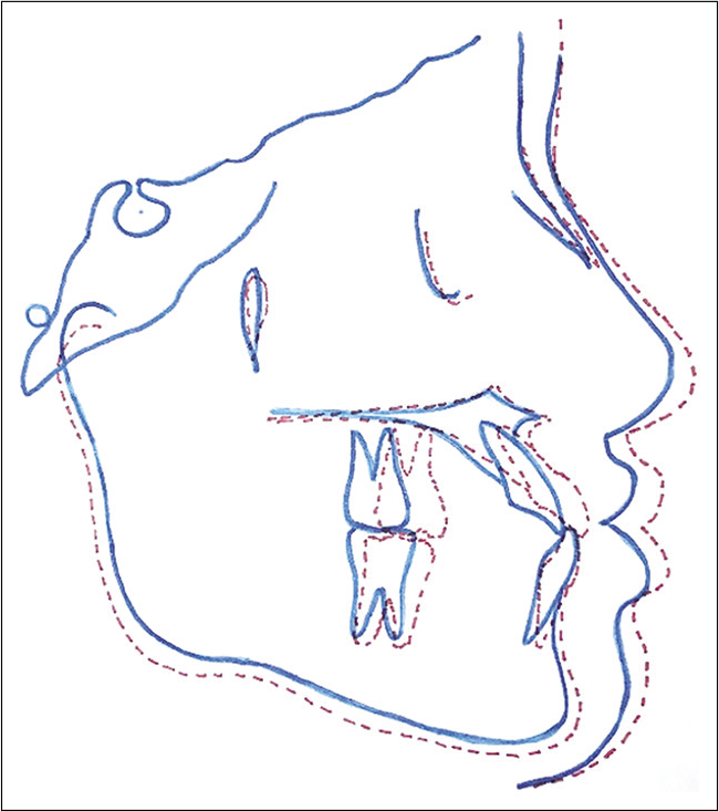 Superimposition before and after maxillary protraction treatment showing the point A has moved further forward than point B, and a discrete anti-clockwise rotation that occurred in the palatine plane.