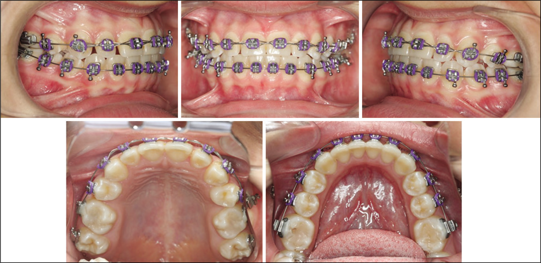 Orthodontic treatment on course.