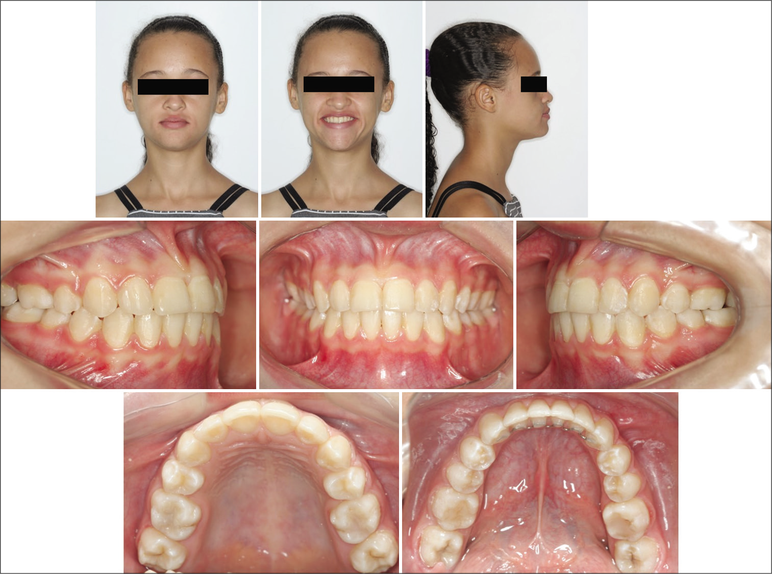 Final clinical aspect 2 years after orthodontic treatment.