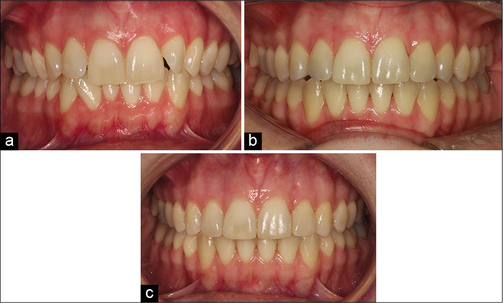 A very mild Class II div 2 malocclusion (a-c) with mild to moderate crowding of both arches (a). Treatment involved use of a customised upper lingual appliance. The maxillary arch was over-expanded resulting in buccal displacement and flaring of 13 (b). Local wire-bending and detailing were required to address this complication leading to excessive treatment duration (23 months).