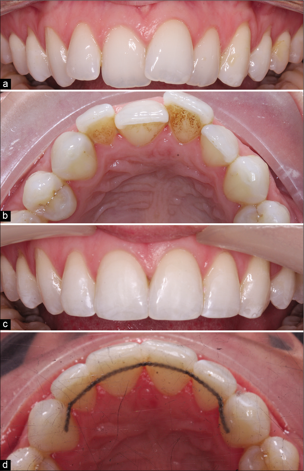 Malaligned upper anterior teeth (a, b) treated with a very brief phase of fixed appliance-based orthodontics (c, d). Treatment was undertaken over a period of just 33 days with appliances removed prematurely. While acceptable alignment of the incisors has been achieved, torque correction on 13 would necessitate more comprehensive treatment with full three-dimensional control.
