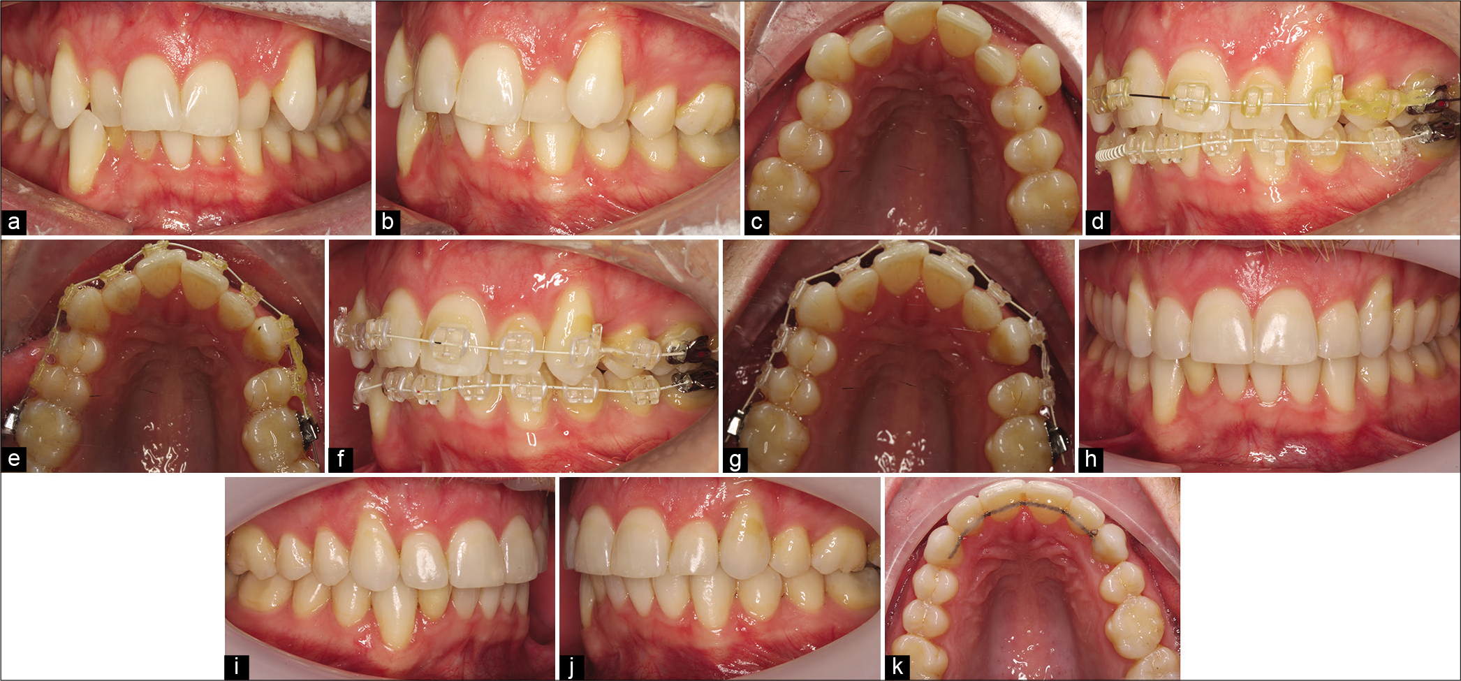 A Class I malocclusion with dual-arch crowding, asymmetric molar relationships, and thin gingival biotype (a-c). Treatment involved upper and lower fixed appliances with loss of 24 in isolation to facilitate relief of crowding, alignment, and improvement of the midline shift. Immediately following extractions, light elastomeric chain was used locally to align 23 and to facilitate early space closure in this adult patient. At 6-week review (d and e), dramatic space closure had already been achieved with a significant excess of wire distal to 26. Very light elastomeric chain was subsequently reapplied (f and g) to finalize space closure with treatment completed in a period of 11 months (h-k).