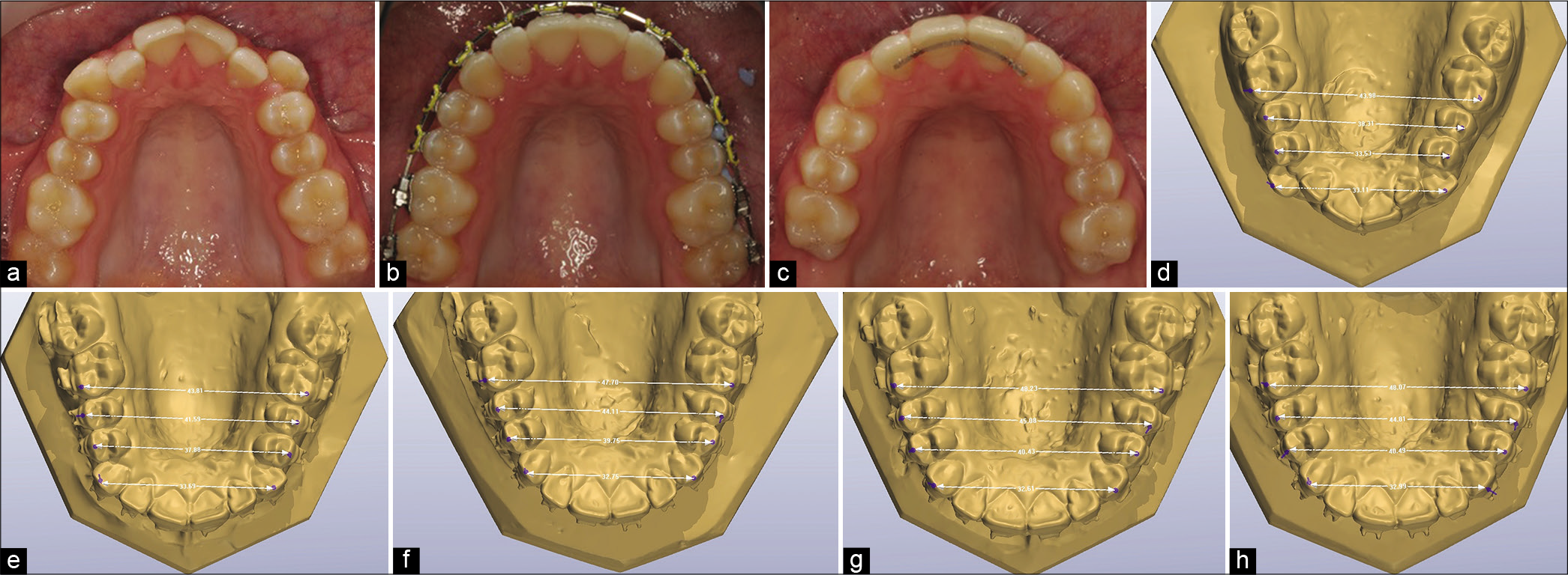 A mild Class III malocclusion with buccally displaced canine and narrow inter-premolar dimension (a). Following engagement of the archwires in the buccally displaced canines, significant dental expansion was achieved without recourse to adjuncts (b and c). The initial buccolingual position of the canines (d) contributed to the final arch form due to its anchorage value. Following engagement of a 0.014 inch Ni–Ti 4 mm of inter-premolar expansion arose (e). This increased to 6–7 mm in 14 × 25 inch (f) and 18 × 25 inch (g) Ni–Ti with intermolar expansion developing in more rigid rectangular Ni–Ti wires. Changes were largely consolidated in 19 × 25 inch stainless steel (h).