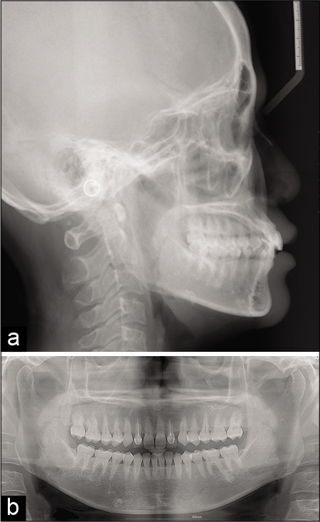 Initial pre-treatment lateral cephalogram (a) and panoramic radiograph (b).