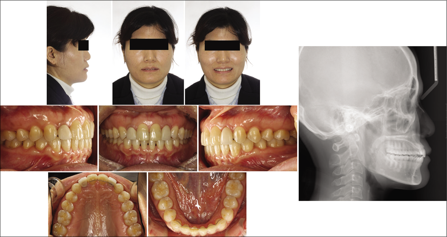Pre-treatment photographs and lateral cephalogram after orthodontic treatment at the private orthodontic office.