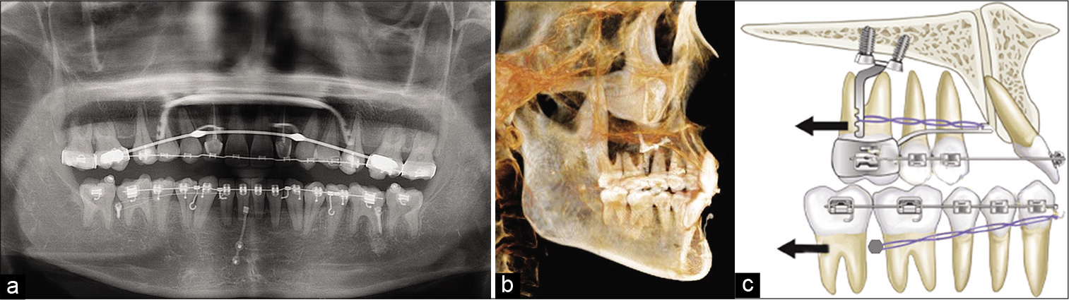Treatment progress radiographs (a) 13 months, (b) 26 months, (c) total arch distalization with modified C-palatal plate in the maxilla and buccal miniscrews in the mandible (black arrow means direction of distalization).