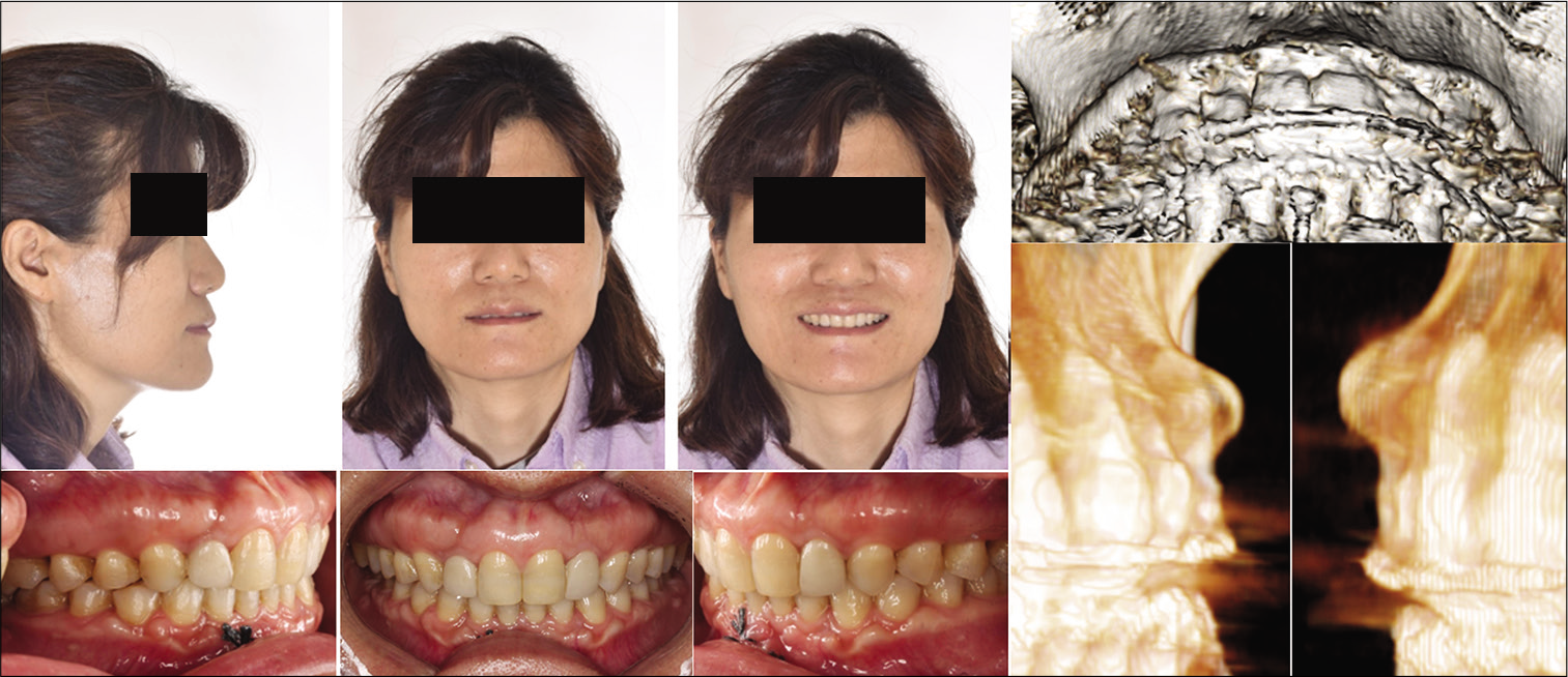 Post-treatment photographs and CBCT images with exostoses between upper right and left canines.