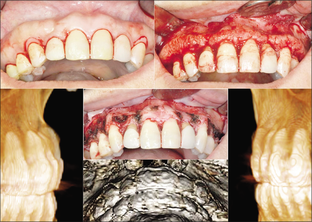 Intraoral photographs during alveoloplasty and CBCT images after alveoloplasty.