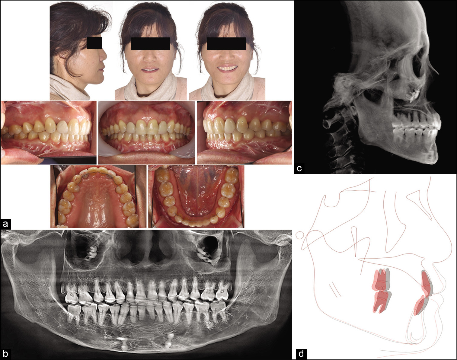 Post-treatment photographs (a), panoramic radiograph (b), lateral cephalogram (c), and superimposition (d).