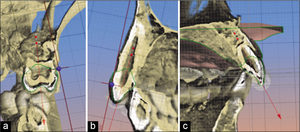 (a) Location of the coronal-root axis, first upper molar, (b) position of the coronal-root axis, upper cuspid, (c) location of the coronal-root axis, upper central incisor.