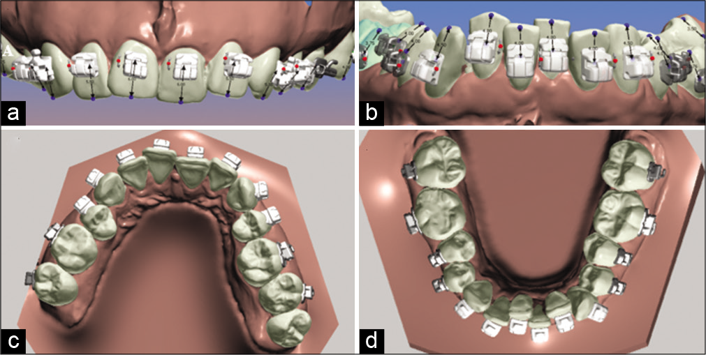 (a) Position of the brackets in the model, upper incisors frontal view, (b) position of the brackets, lower incisors frontal view, (c) occlusal view of the brackets, position in the upper arch, (d) occlusal view of the brackets, position in the lower arch using the Ortho-Analyzer Software.