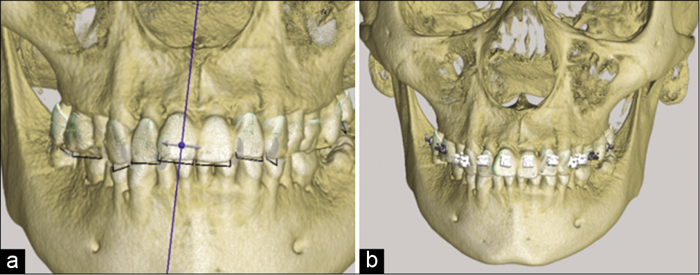 (a) Location of axes in tomography, long axis of the tooth, (b) location of the brackets in tomography positioned with the long axis of the tooth.