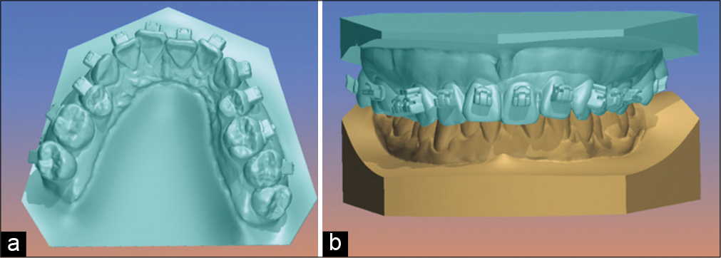 (a) Upper model occlusal view, where we observe the virtual filling of retention areas such as bracket tubes and fins, (b) frontal view of the upper model with the lower arch.
