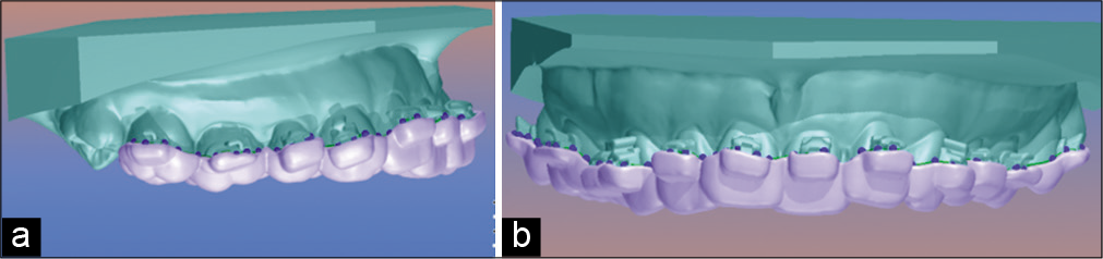 (a) Guide design mounted on the upper model, lateral view, (b) guide design mounted on the upper model, frontal view.