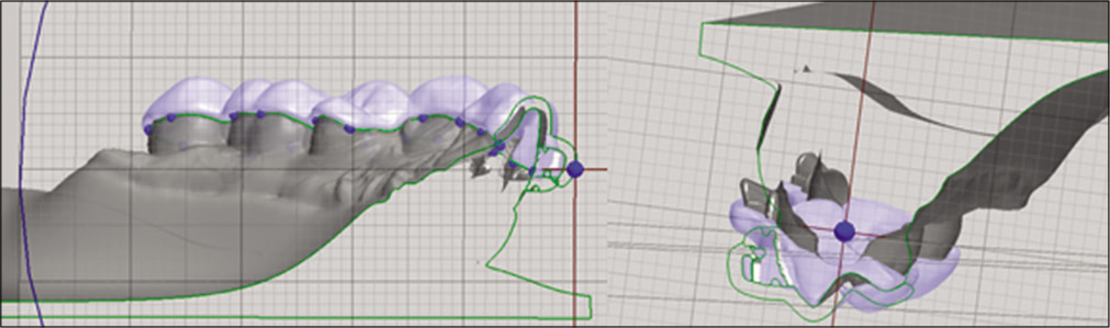 Sagittal section of the scan including the virtual model, the brackets, and digital tube. Here, we are able the thickness and precision of the guide.