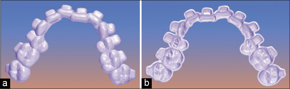 (a) Digital upper guide finished, occlusal view, (b) digital upper guide finished, inside view.