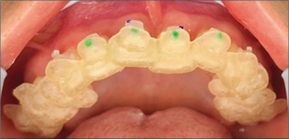 Placement of brackets with complete upper guide.