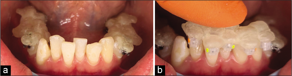 (a) Placement of brackets with the segmented lower guide in molars and bicuspids, (b) placement of brackets with the segmented lower guide in cuspid and incisors.