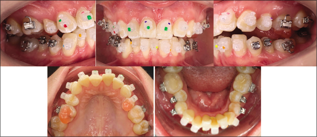 Tray removed by teasing out with hemostat along gingivae above or below brackets and then rolling lingually.