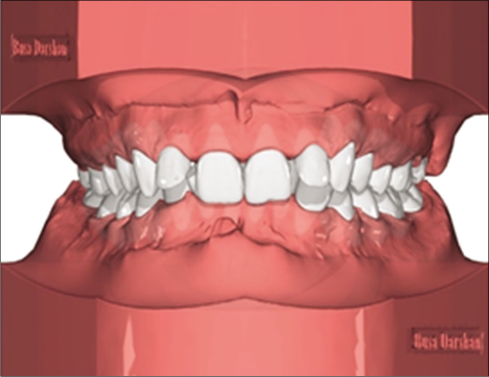 Segmentation of individual tooth.