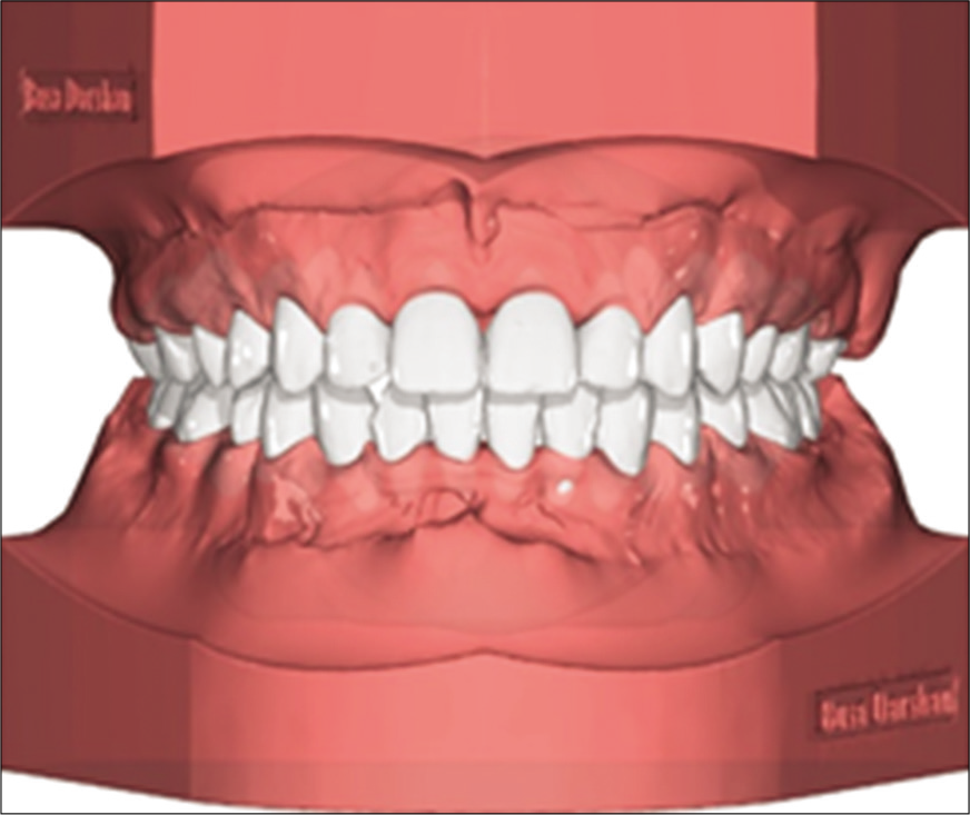 Virtual treatment setup.