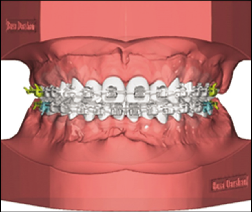 Digital orthodontic indirect bonding systems A new wave APOS Trends