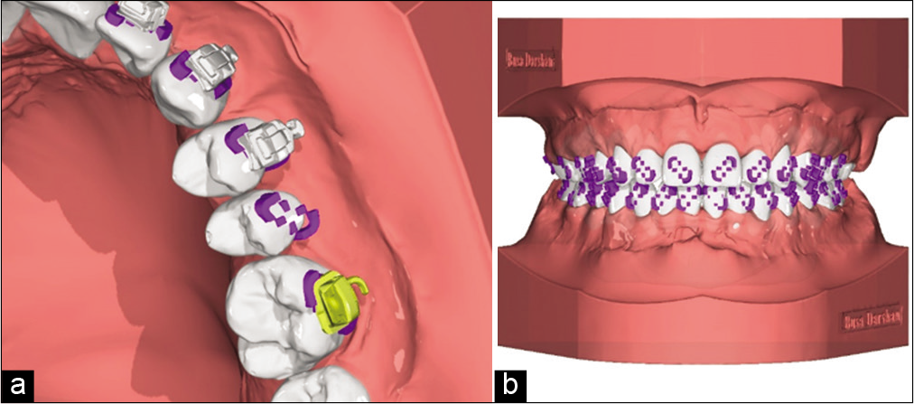 Torque compensation on individual bracket by digitally constructed base, (a) closeup view with and without brackets, (b) bracket support model ready for printing.