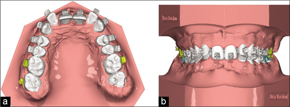 Bracket positioning based on VTO transferred to malocclusion (a) occlusal view , (b) Frontal view.