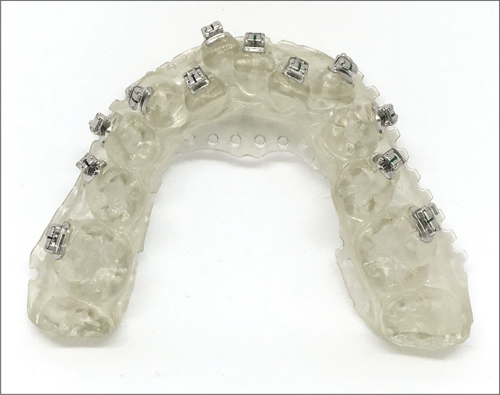 Orthodontic brackets bonded on Torque compensation.