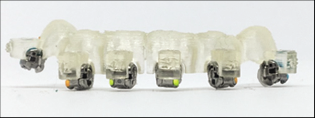 Printed indirect bonding trays segmented in part for bonding.