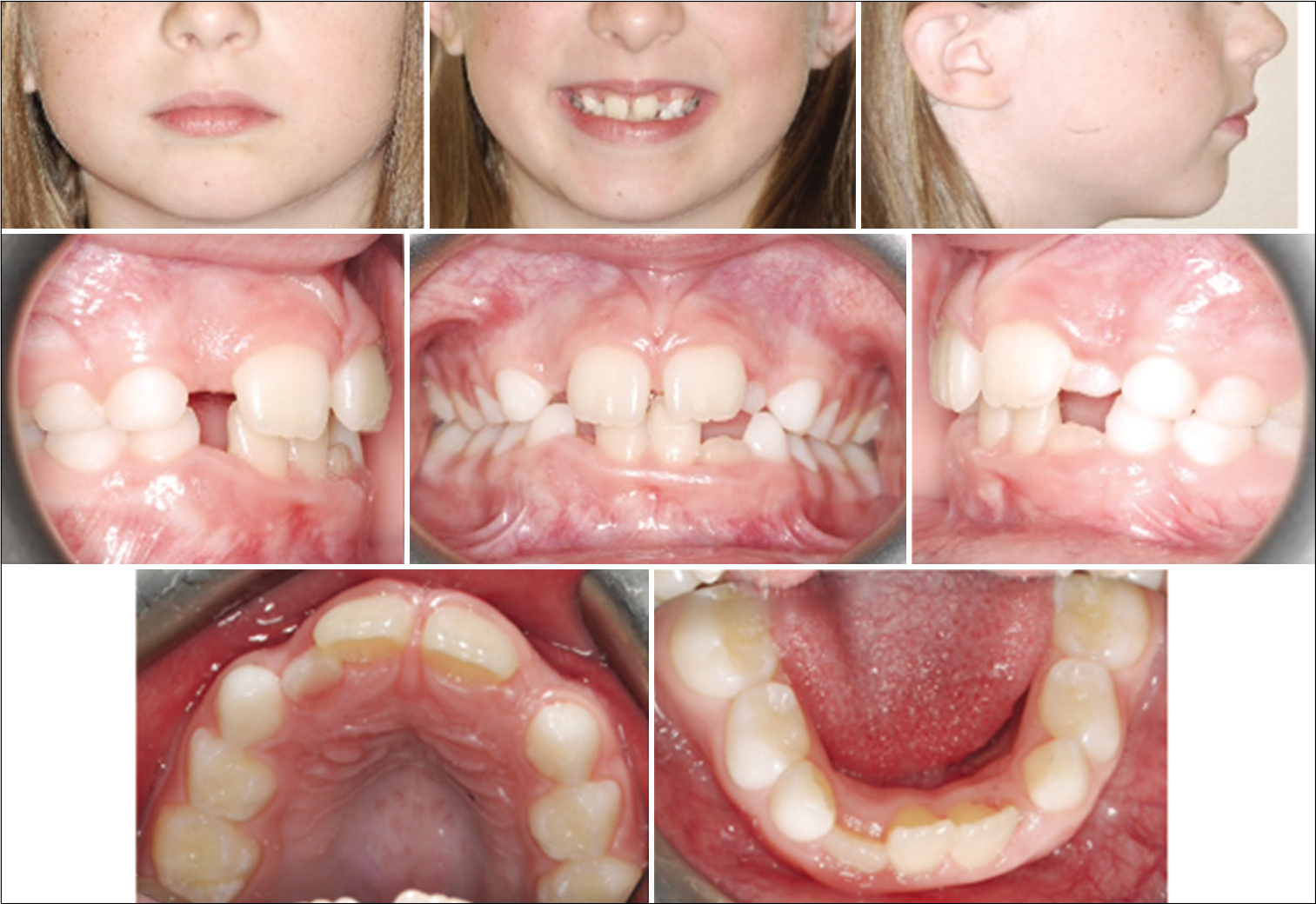Case 1 pre-treatment facial and intraoral photographs. An 8-year-old female with crowding in the upper anterior teeth.