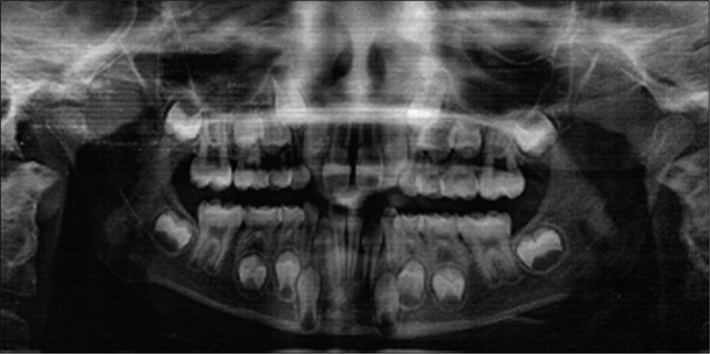 Case 1 pre-treatment panoramic radiograph.