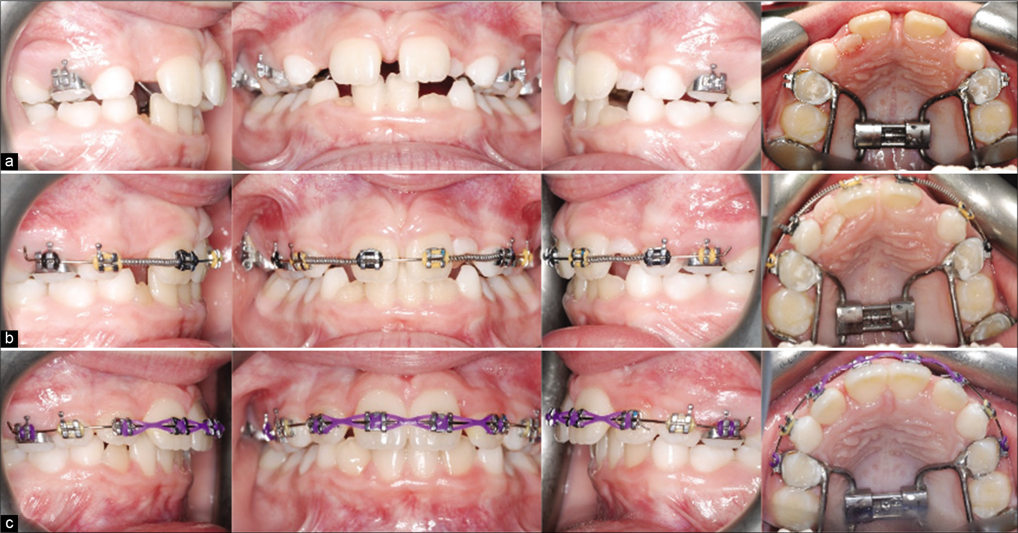 Case 1 (a) progress treatment photographs after maxillary expansion. (b) Progress treatment photographs showing the use of coiled springs to close diastema. (c) Progress photographs of alignment of maxillary incisors.