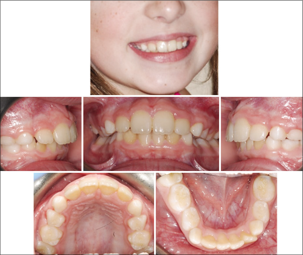 Case 1 post-treatment facial and intraoral photographs.