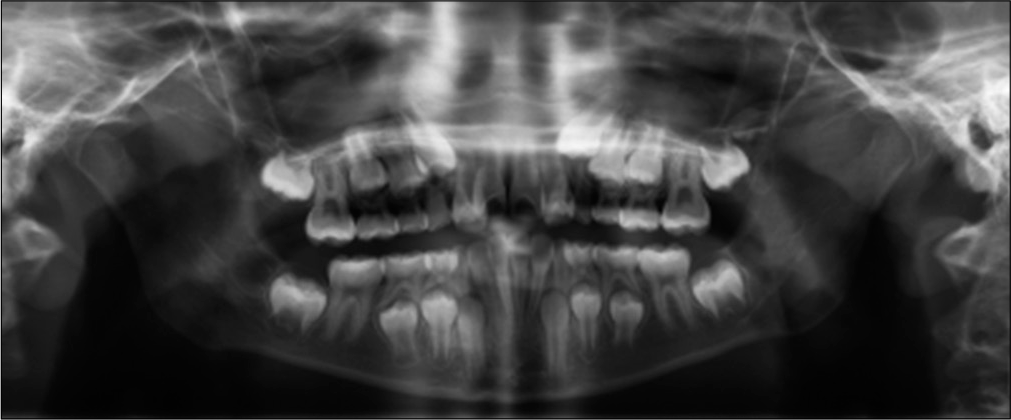 Case 2 pre-treatment panoramic radiograph.