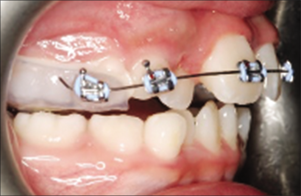 The technique of bonding a bracket on the buccal surface of a bonded RPE.