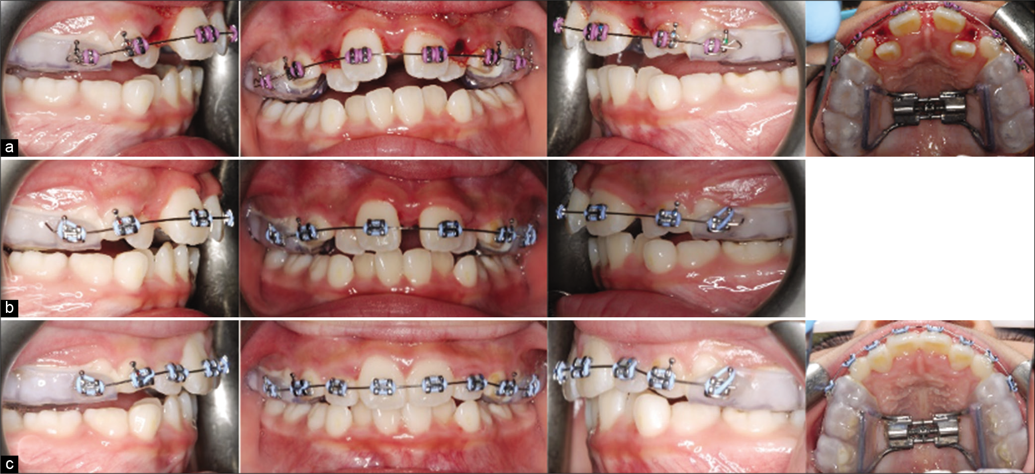 Case 2 (a) progress treatment photographs after maxillary expansion. Notice the bite-opening immediately after expansion. (b) Settling of the posterior occlusion after 2 months. (c) progress treatment photographs showing alignment of the maxillary incisors.