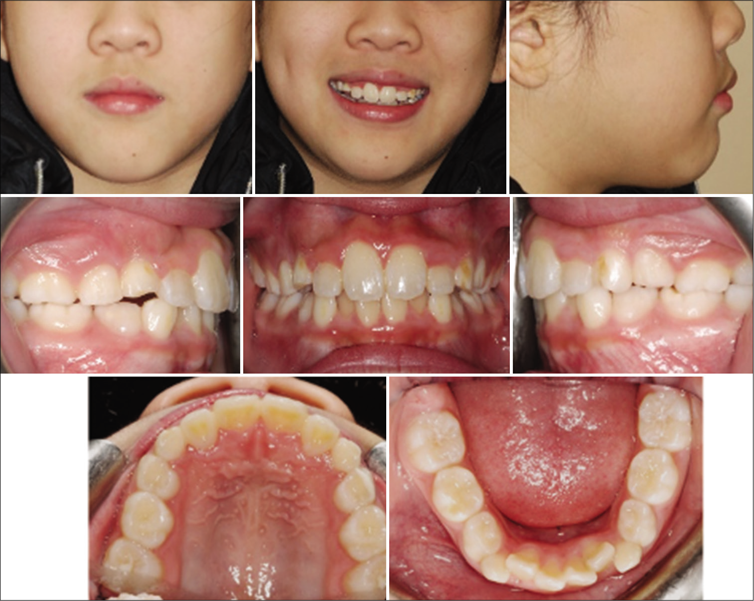 Case 2 post-treatment facial and intraoral photographs.
