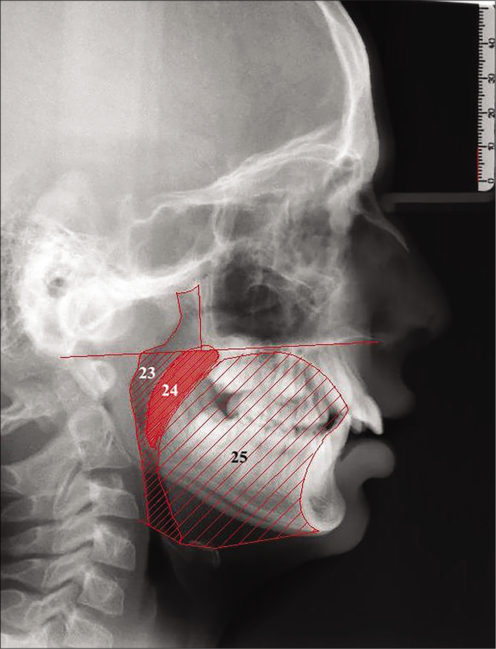 Area measurements of the study: 23: Oropharyngeal area (mm2), an area limited superiorly by a backward extension of the maxillary plane and inferiorly by a line joining E and C3 points; 24: Uvula area (mm2), an area formed by outer boundaries of uvula and limited superiorly by maxillary plane, 25: Tongue area (mm2), an area surrounded posteriorly by the oropharynx and uvula, superiorly by the maxillary plane, anteriorly by the lingual aspects of the anterior teeth and lingual mandibular symphyseal contour and inferiorly by the line extending from the point E to the point H and the line joining H and Me points.