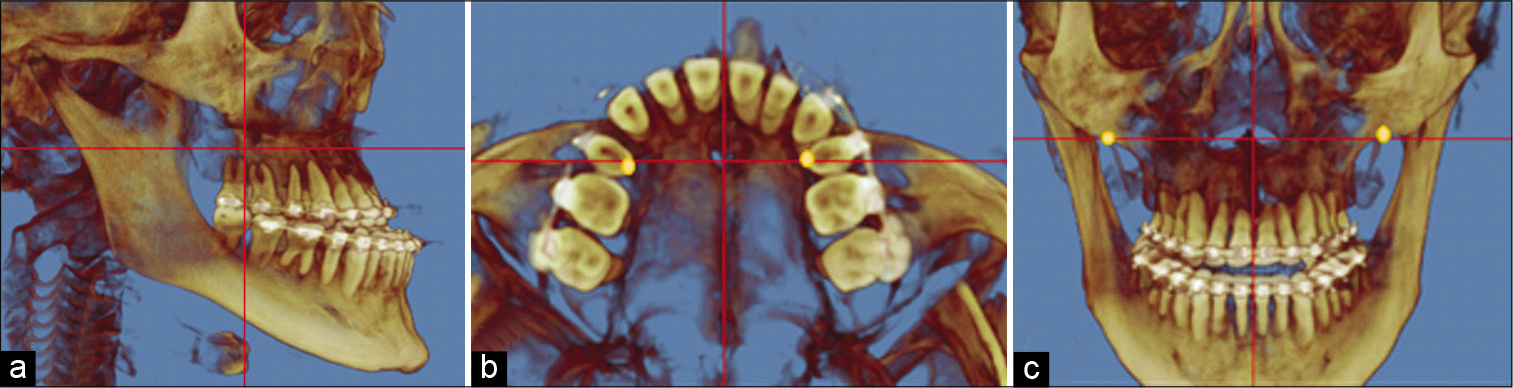Cone-beam computed tomography head orientation in three planes of space; (a) sagittal, (b) axial, and (c) coronal.