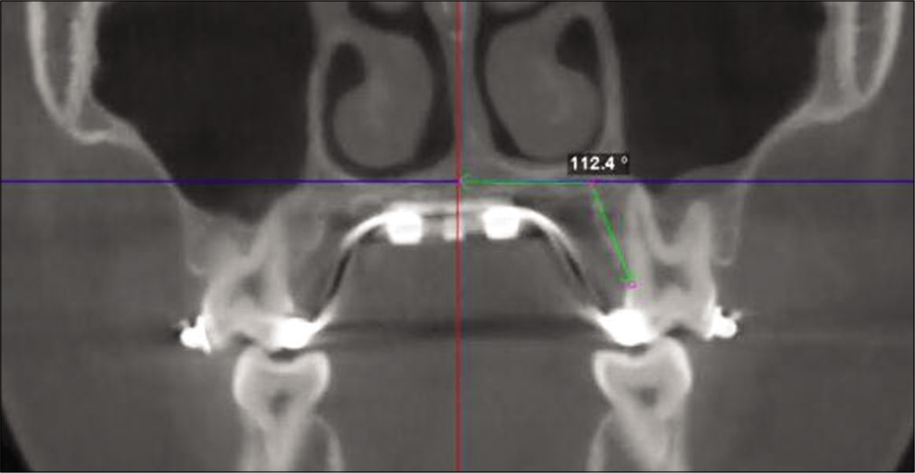 Measurement of alveolar bone bending angle for first molar by measuring the intersecting angle formed by a best fit line through the palatal cortical plate and the software’s horizontal indicator line that transverse the middle of the palate.