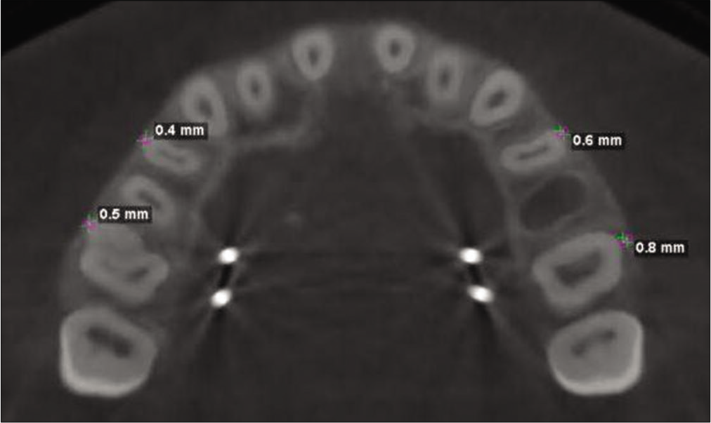 Measurement of buccal bone thickness for first pre-molar and mesiobuccal root of first molar.