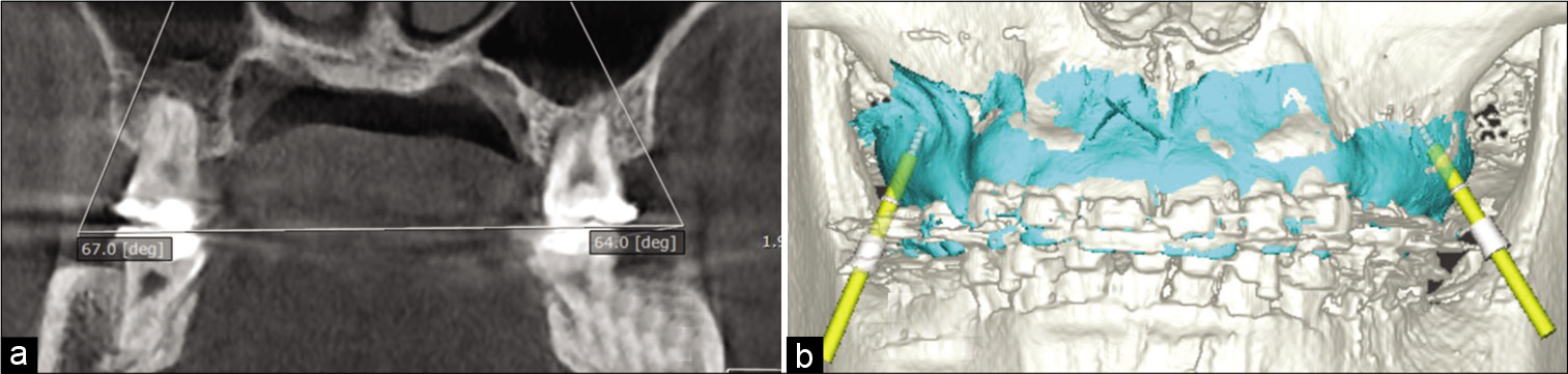 Infrazygomatic crest miniscrew position was planned using cone-beam computed tomography (a) which was fused with digital model images (blue) before the driver key (yellow rods) was located (b).