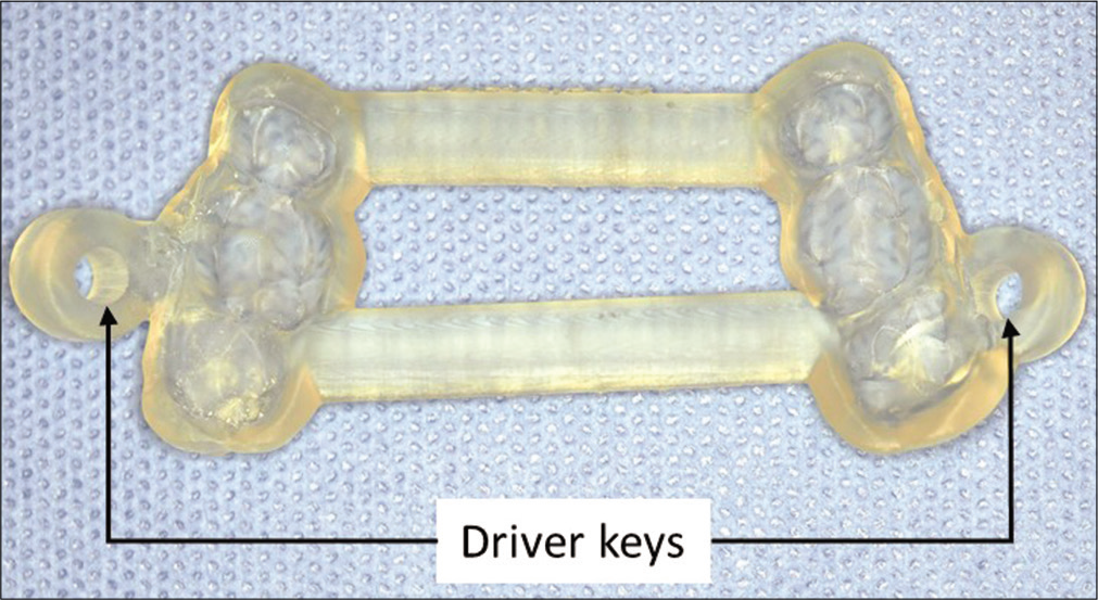 Computer-aided design and manufacturing surgical guide with two driver keys.