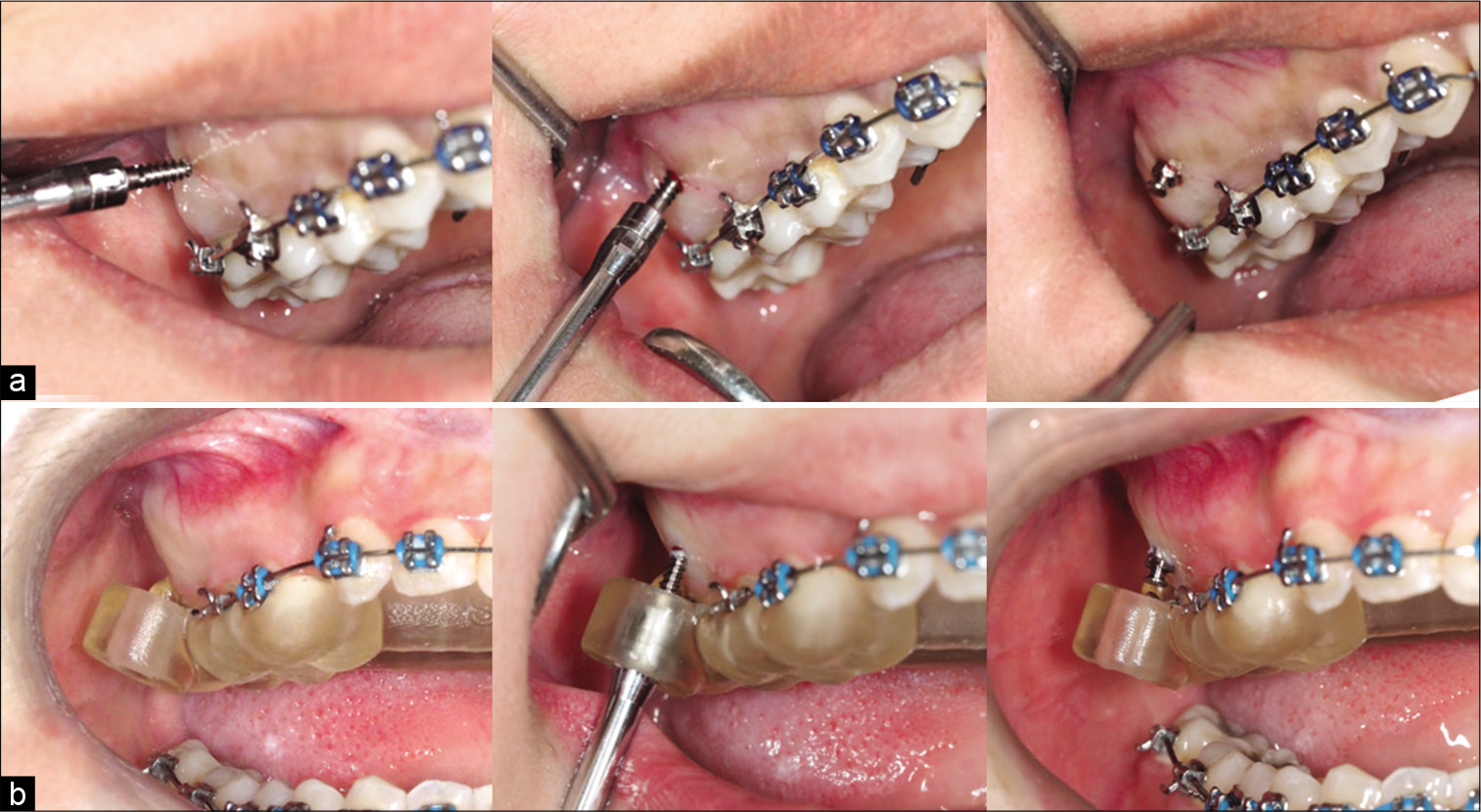 Miniscrew insertion method direct insertion (a) and CAD/CAM surgical guide (b) groups.